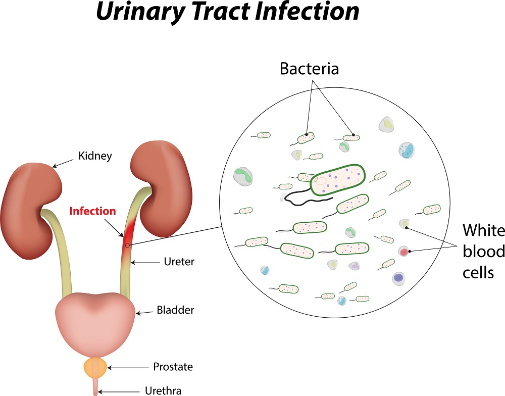 urinary tract infection treatment online