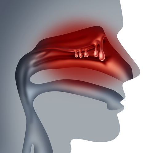 nasal polyps sinus infections