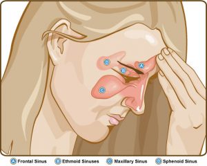 upper sinus infection