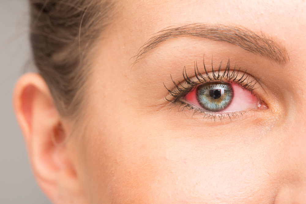 common eye allergy symptoms